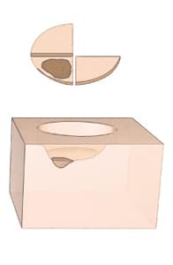 Illustration af kræftrester, der er fundet i kanten